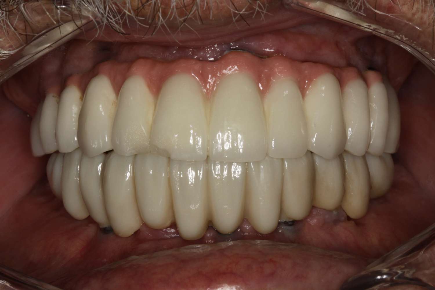 Close-up view of a patient's smile showing a set of natural-looking, bright white teeth after dental restoration at Davie Advanced Dentistry.
