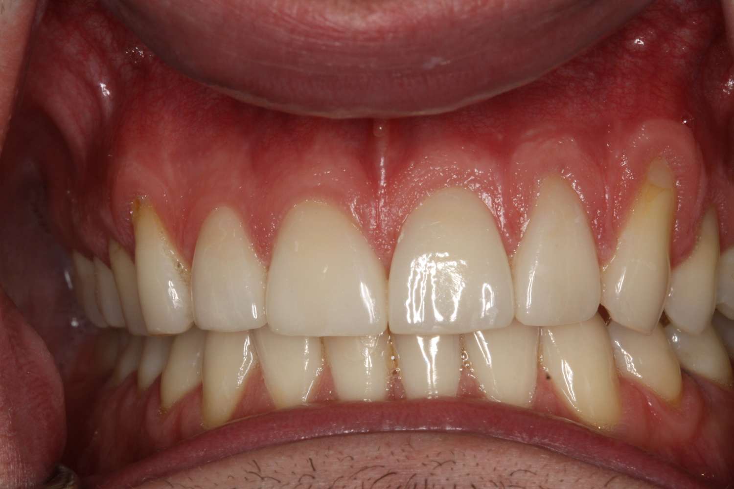 Close-up of healthy teeth and gums showcasing dental care results at Davie Advanced Dentistry, emphasizing quality oral health and cosmetic dentistry.