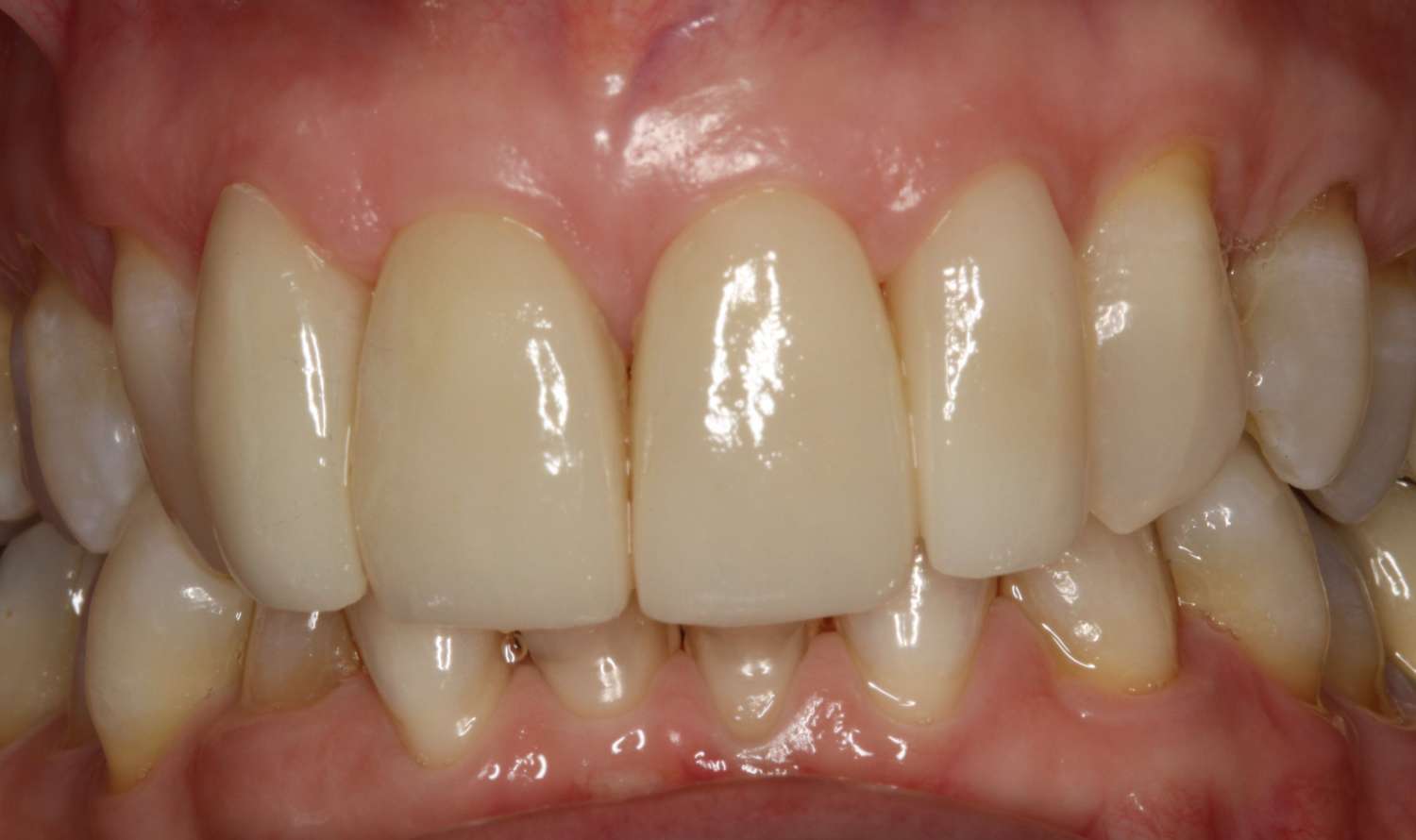 Close-up of a healthy smile showcasing well-aligned, white teeth and healthy gums, representing dental care services at Davie Advanced Dentistry in Davie, FL.