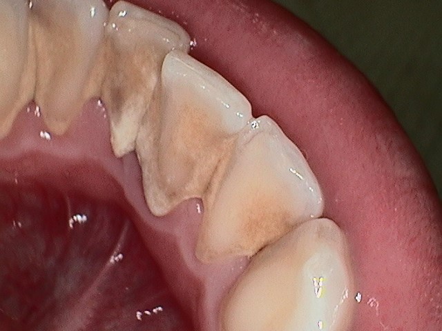 Close-up of upper teeth showing dental condition, relevant to dental care services at Davie Advanced Dentistry.