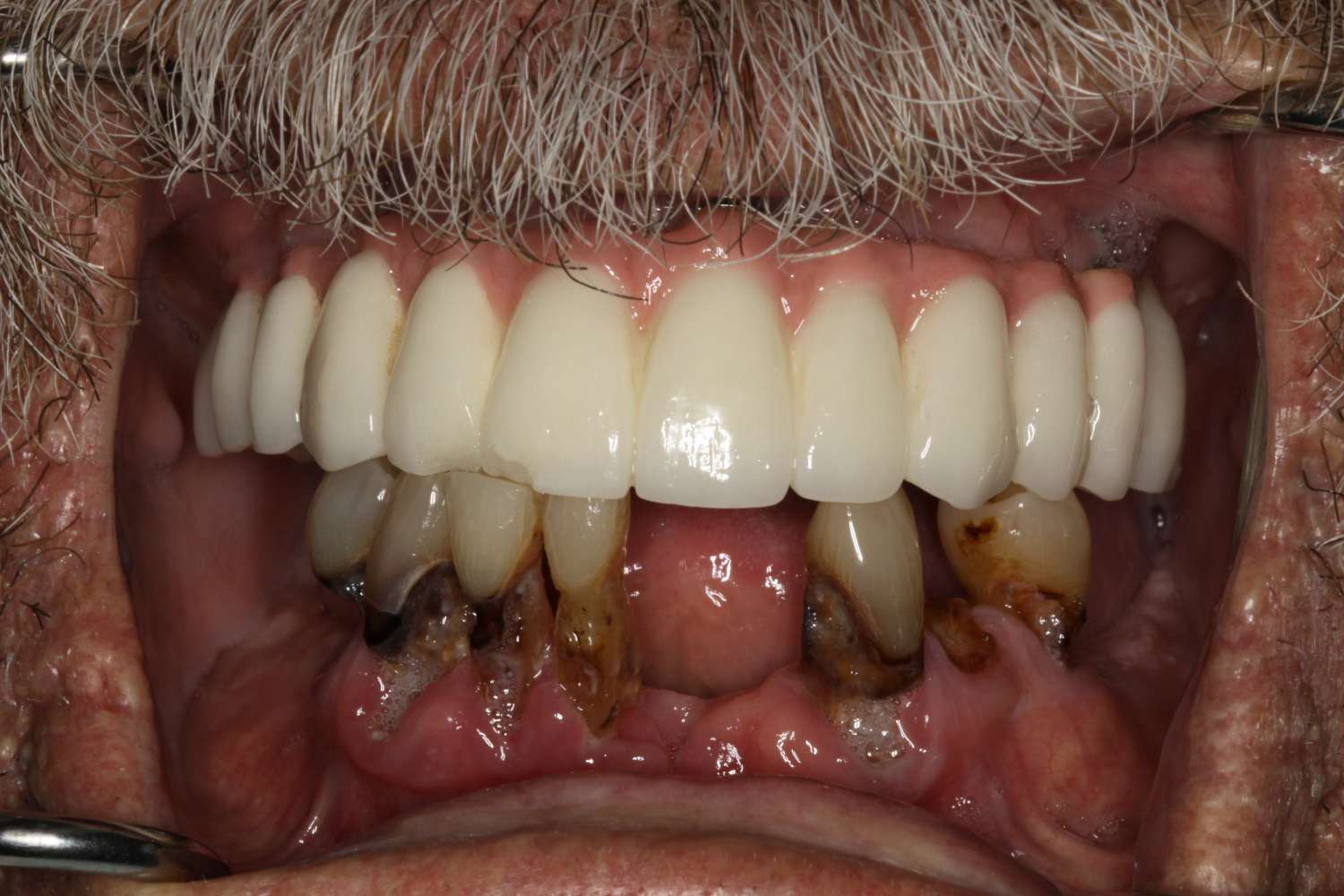 Close-up of a patient's mouth showing a mix of healthy and decayed teeth, highlighting dental restoration work relevant to Davie Advanced Dentistry's comprehensive dental care services.