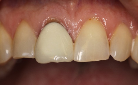 Close-up of teeth highlighting a dental restoration procedure, relevant to comprehensive dental care services offered by Davie Advanced Dentistry.