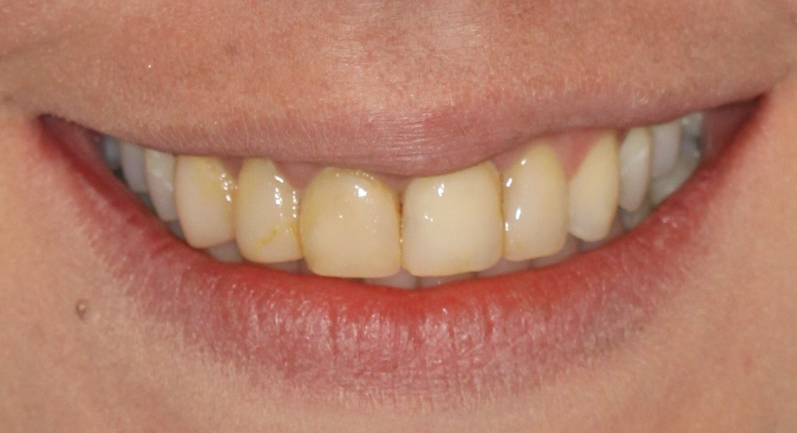 Close-up of a person's smile showing yellowed teeth, highlighting dental health concerns relevant to Davie Advanced Dentistry's restorative and cosmetic services.