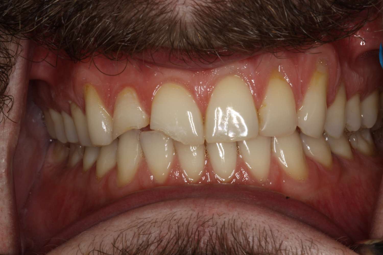 Close-up of a patient's mouth showing healthy teeth and gums, illustrating dental health and care relevant to Davie Advanced Dentistry's services.