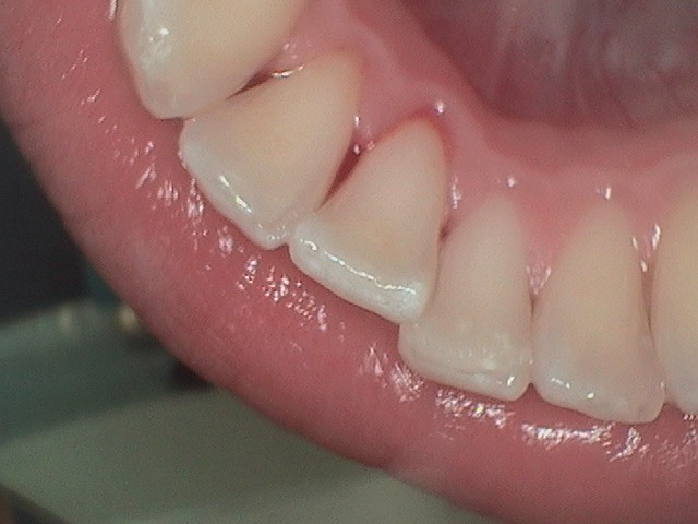 Close-up of healthy teeth and gums, showcasing dental care and hygiene relevant to Davie Advanced Dentistry services.