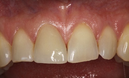 Close-up of healthy front teeth showing natural shape and color, relevant to dental care and cosmetic dentistry services at Davie Advanced Dentistry.