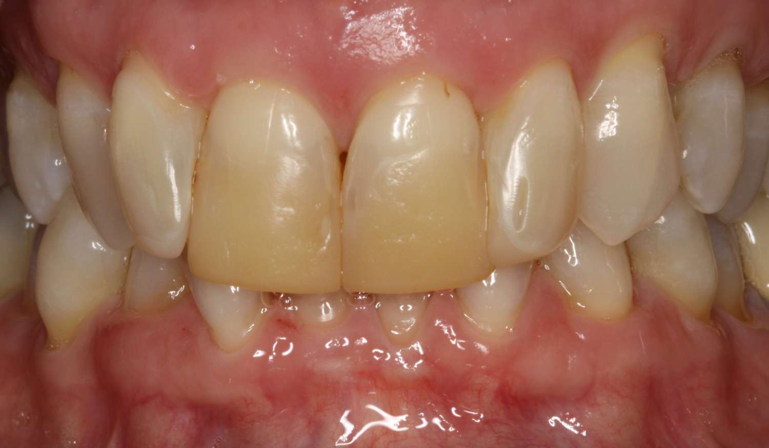 Close-up image of a dental patient’s upper front teeth showing a mix of natural and restorative dental work, highlighting the importance of cosmetic dentistry at Davie Advanced Dentistry.